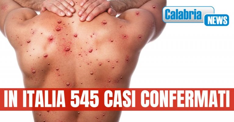 Vaiolo delle scimmie: La Calabria resta tra le Regioni che non hanno segnalato presenza virus
