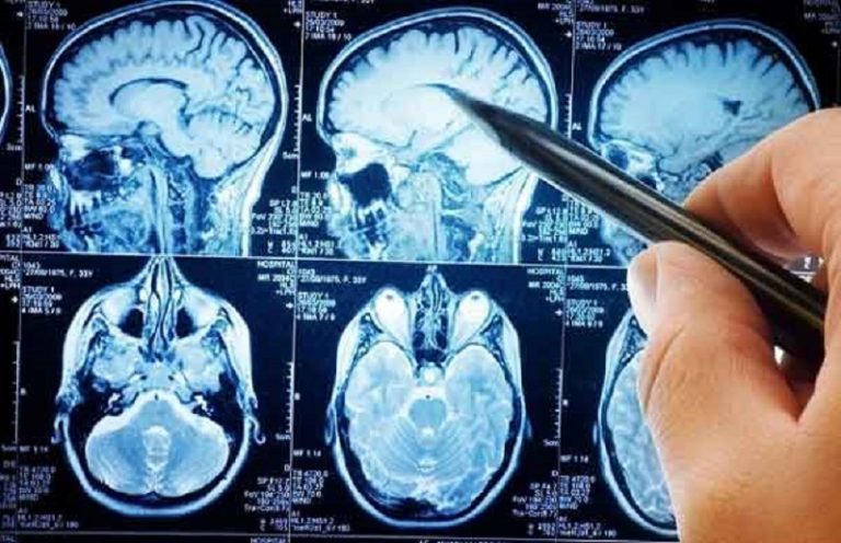 Alzheimer, scoperta molecola che frena la malattia. Studio italiano potrebbe portare a sviluppo farmaco