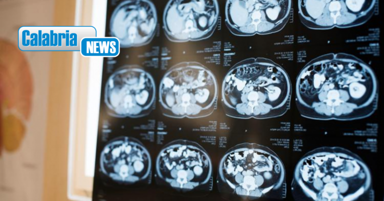 Alzheimer, scoperto in Italia nuovo gene che lo provoca: lo studio