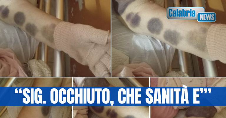 Cosenza, la signora Rita Palumbo denuncia: mia madre rimasta in pronto soccorso per 10 giorni