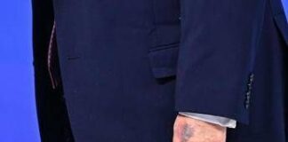 Trump e il nuovo livido sulla mano, tutte le ipotesi secondo Bassetti