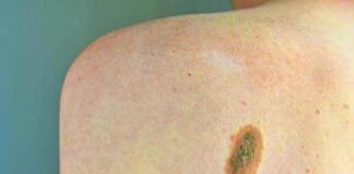 Melanoma, Adoi: “Bene nuova legge su prevenzione, dermatologo centrale in screening”
